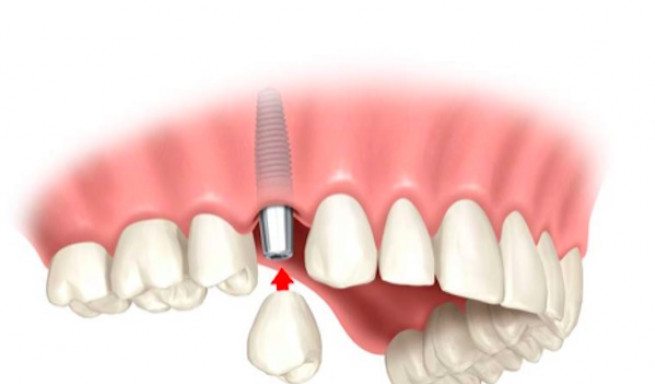 tooth